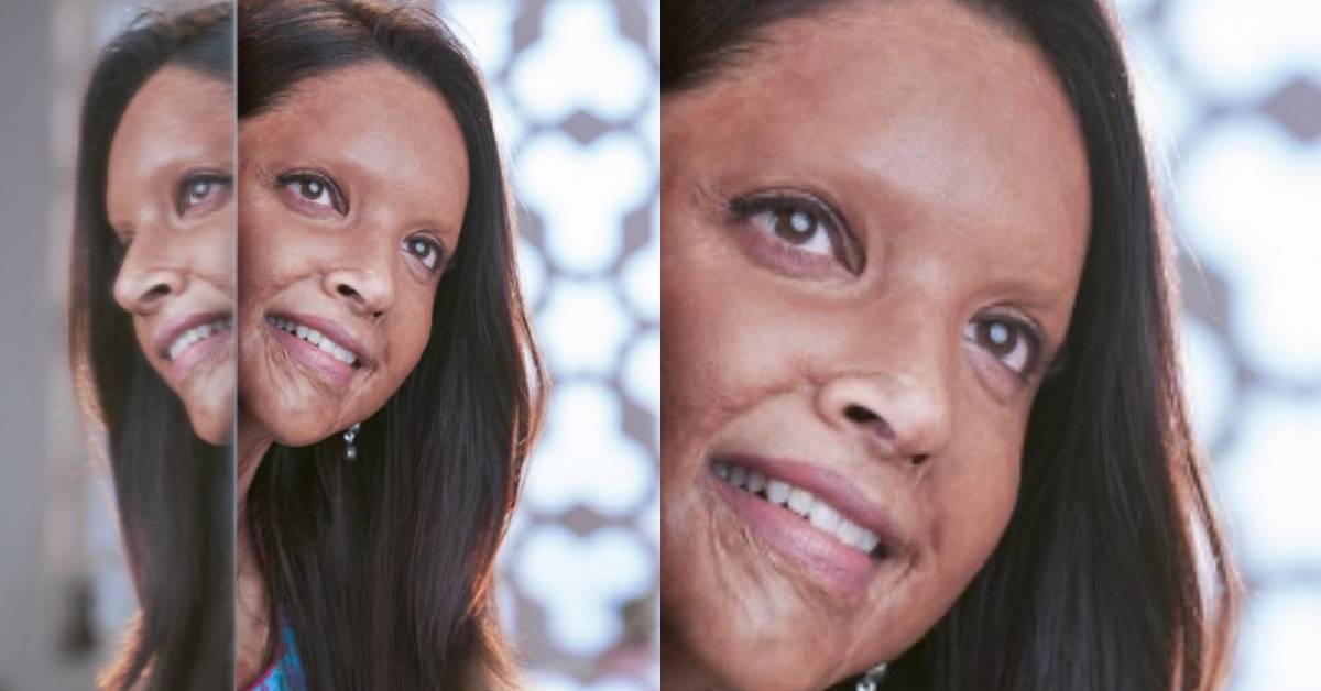 Chhapaak: Deepika Padukone's First Look From The Film Is Finally Here And It Has Definitely Given Us Some Major Goosebumps!
